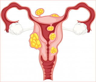 Consult With Doctor For Fibroids